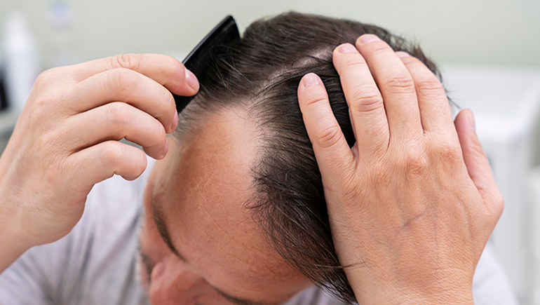 <a href='https://www.freepik.com/photos/hair-loss?2b9j9ort87'>Hair loss photo created by freepik - www.freepik.com</a>